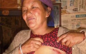 बोक्सी लागेको भन्दै  खुकुरी तताएर डामियो