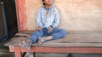 शिवसताक्षीका एक बालक ९ वर्षदेखि दाम्लोमा