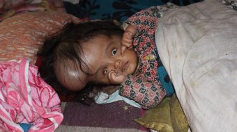 अस्वभाविक टाउकाे बढेकी पवित्रालार्इ लायन्स क्लबकाे सहयाेग